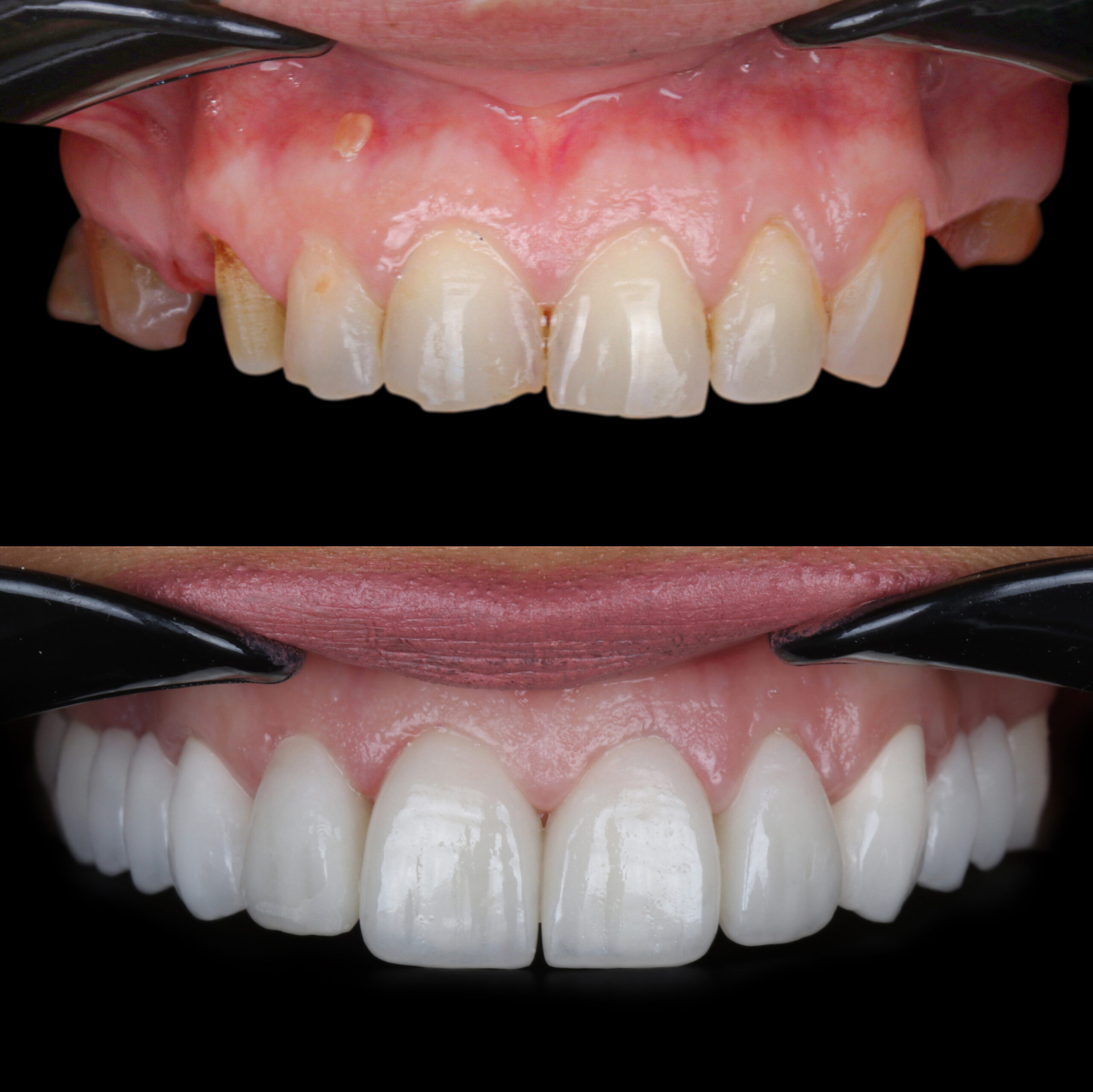 Veneer before and after smile transformation