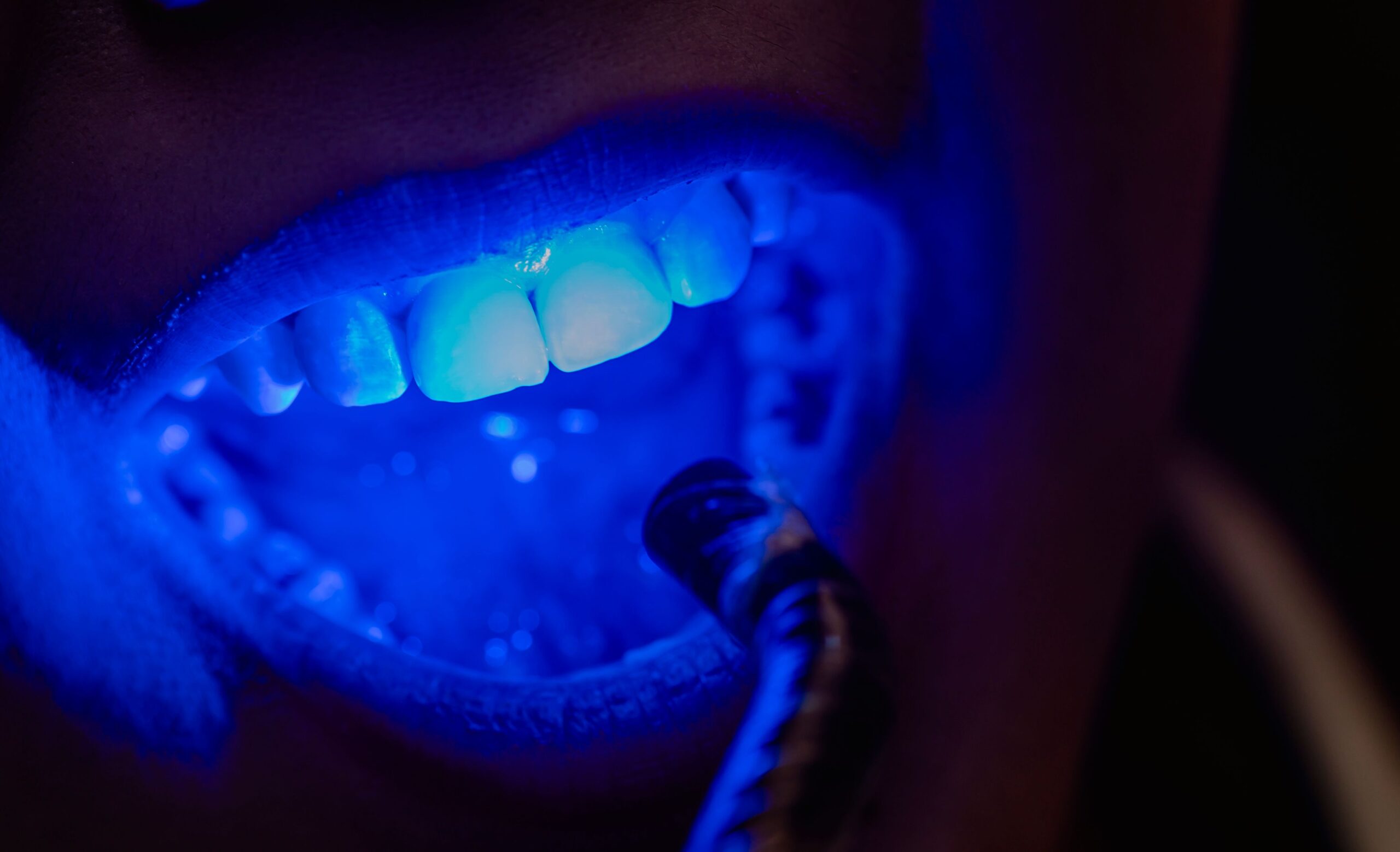 Professional teeth whitening